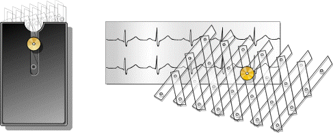 EKG Fence